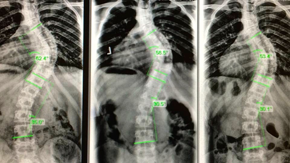 3 spine pics