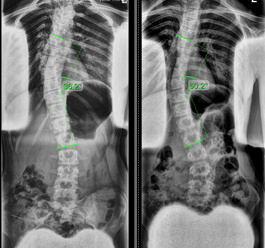 spine-x-ray